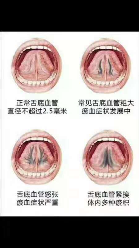 【荟之源分享健康】舌头静脉淤堵的发出的提示健康信号